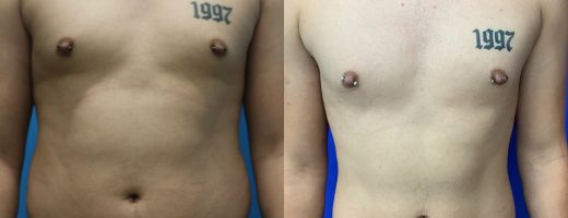 Before and After - 360 Liposucción