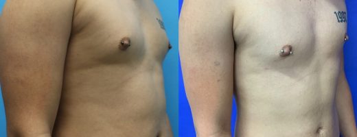 Before and After - 360 Liposucción