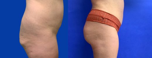 Before and After - 360 Liposucción