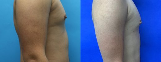 Before and After - 360 Liposucción