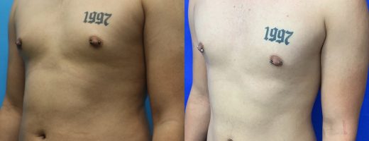 Before and After - 360 Liposucción