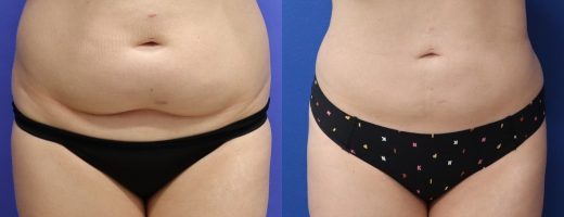 Before and After - 360 Liposucción