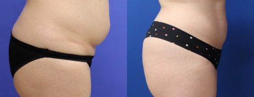 Before and After - 360 Liposucción