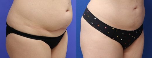 Before and After - 360 Liposucción