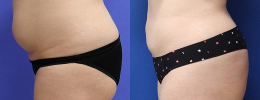 Before and After - 360 Liposucción