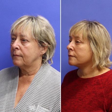 Before and After - Face & Neck