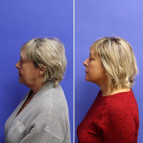 Before and After - Face & Neck