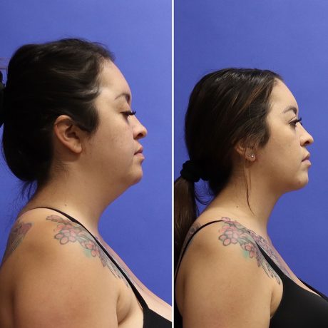 Before and After - Face & Neck