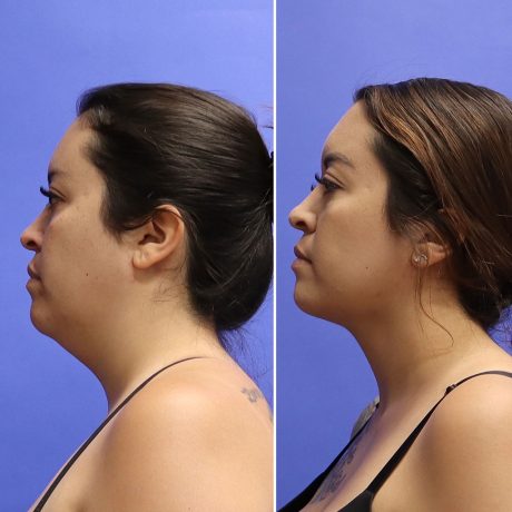 Before and After - Face & Neck