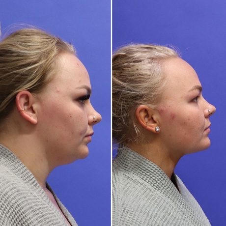 Before and After - Face & Neck