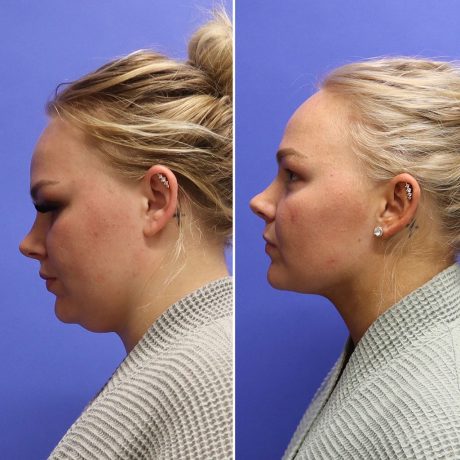 Before and After - Face & Neck