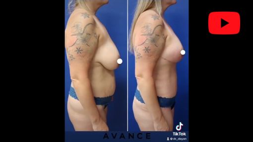 Nipple And Areola Reduction Plastic Surgery Las Vegas NV