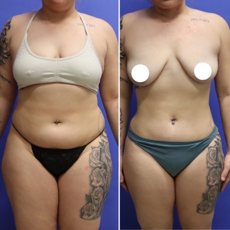 Before and After - 360 Liposucción