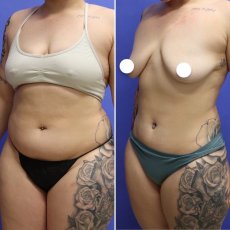 Before and After - 360 Liposucción