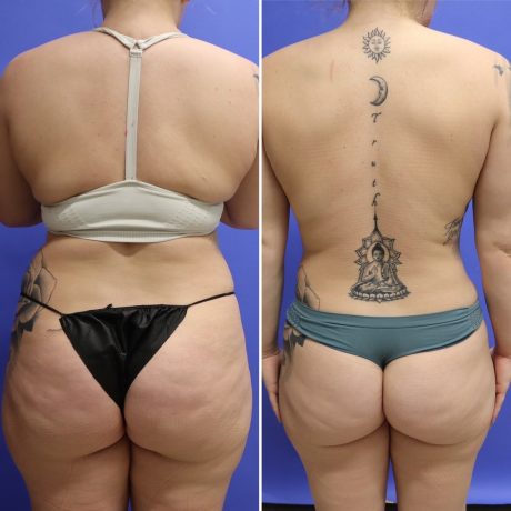 Before and After - 360 Liposucción