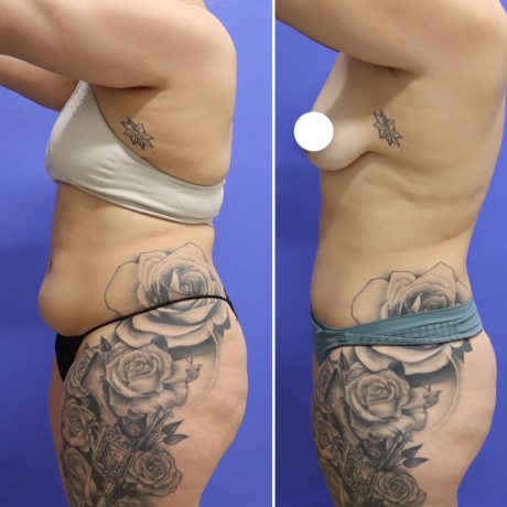 Before and After - 360 Liposucción