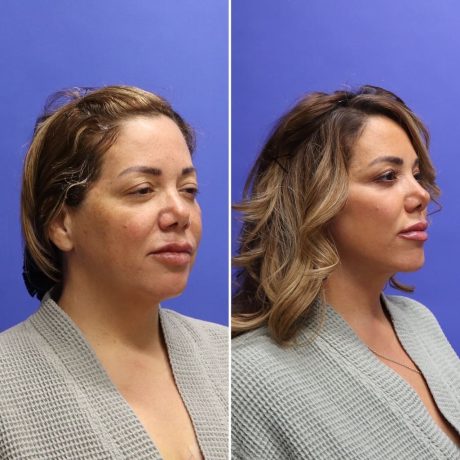 Before and After - Face & Neck