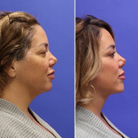 Before and After - Face & Neck