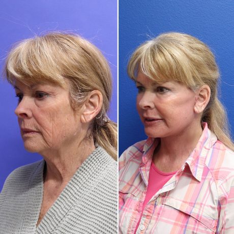 Before and After - Face & Neck