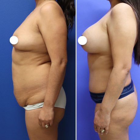 Before and After - Breast Augmentation