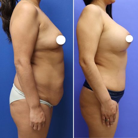 Before and After - Breast Augmentation