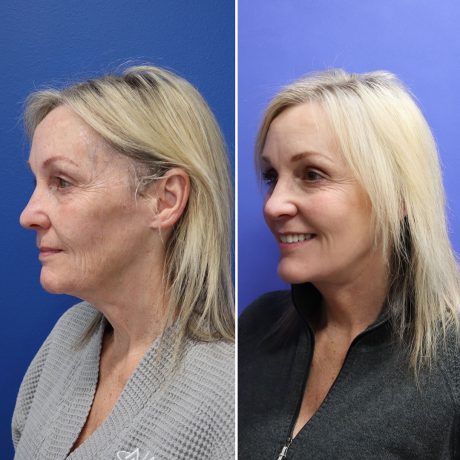 Before and After - Face & Neck