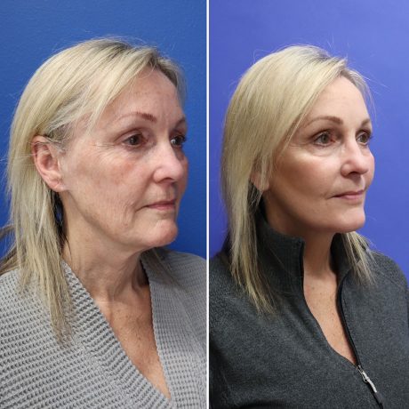 Before and After - Face & Neck