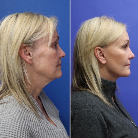 Before and After - Face & Neck