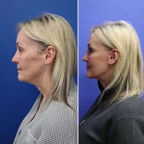 Before and After - Face & Neck