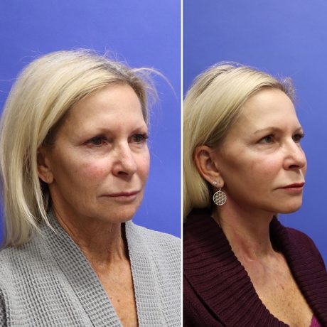 Before and After - Face & Neck