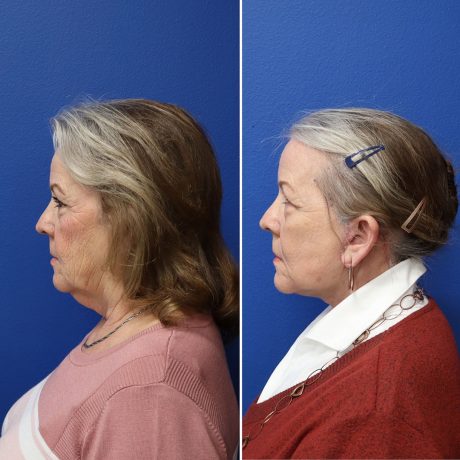 Before and After - Face & Neck