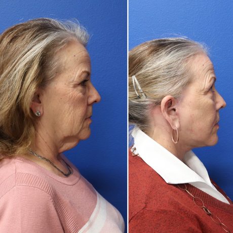 Before and After - Face & Neck