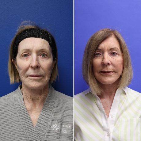 Before and After - Face & Neck