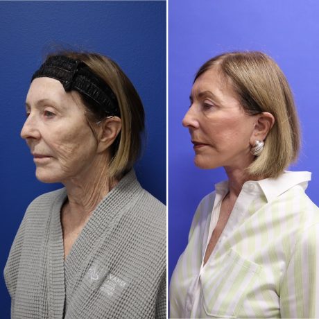 Before and After - Face & Neck