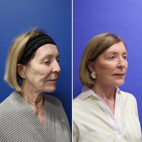 Before and After - Face & Neck