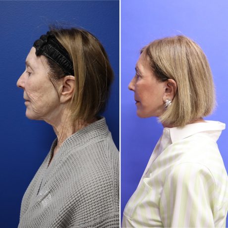 Before and After - Face & Neck