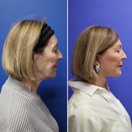 Before and After - Face & Neck