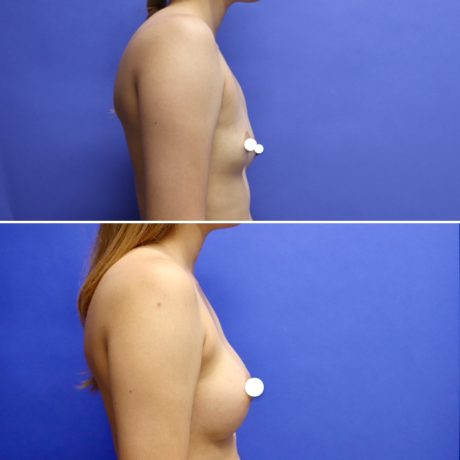 Before and After - Breast Augmentation