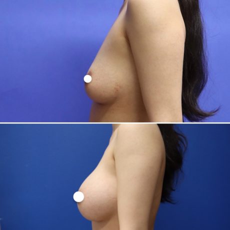 Before and After - Breast Augmentation