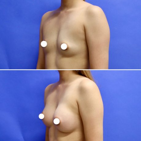 Before and After - Breast Augmentation