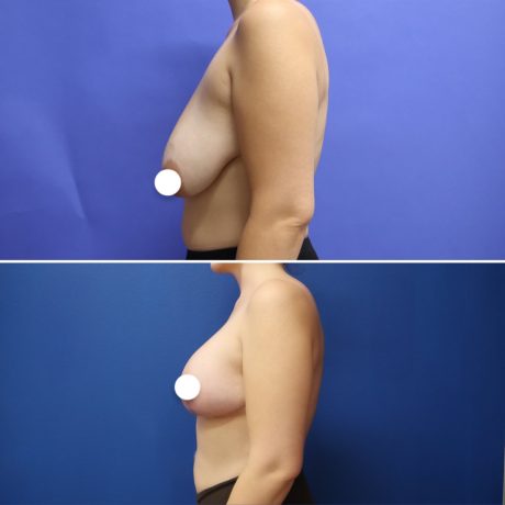 Before and After - Elevación de pecho con implantes (Mastopexia de aumento)