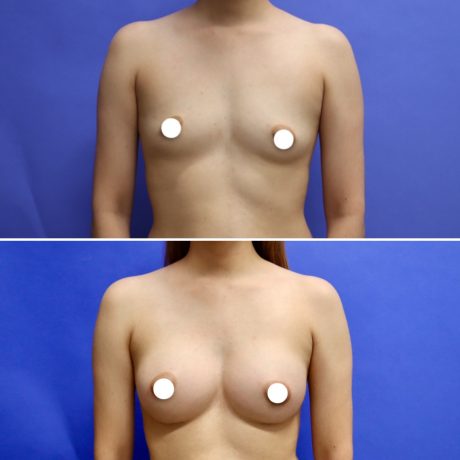 Before and After - Breast Augmentation