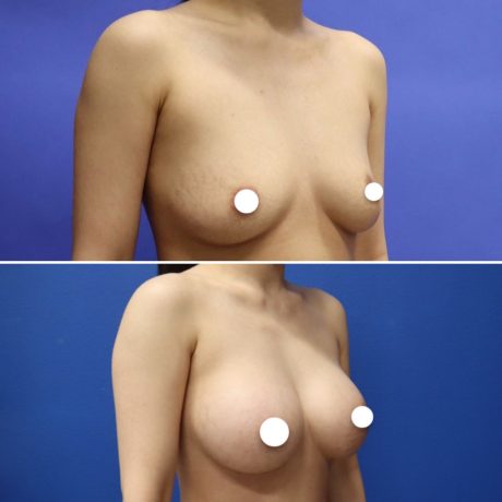 Before and After - Breast Augmentation