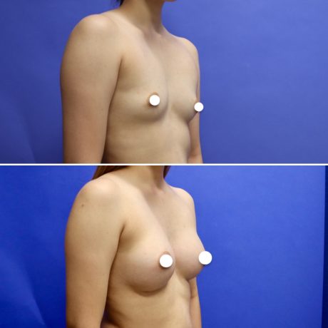 Before and After - Breast Augmentation