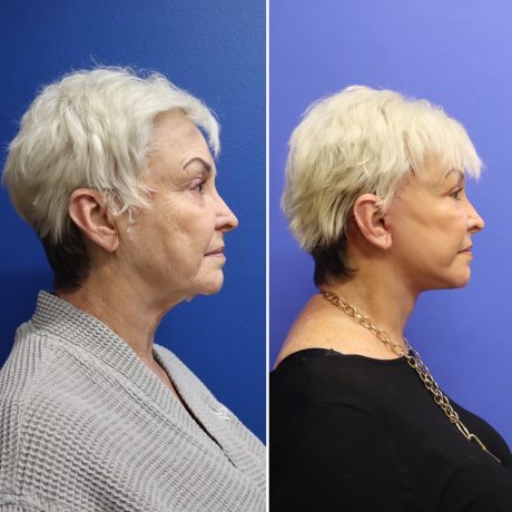 Before and After - Face & Neck