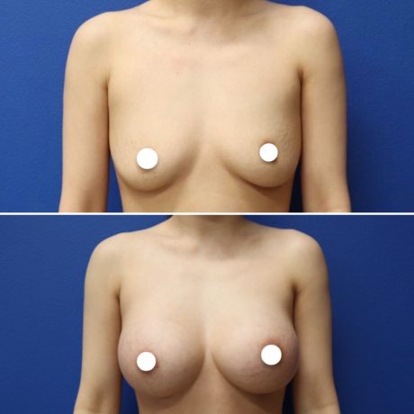 Before and After - Breast Augmentation