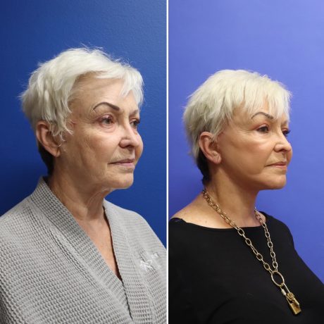 Before and After - Face & Neck