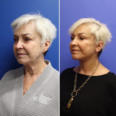 Before and After - Face & Neck