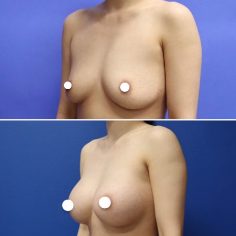 Before and After - Breast Augmentation