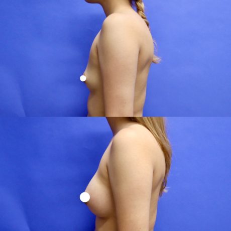 Before and After - Breast Augmentation